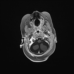 Aqueductal stenosis (Radiopaedia 73974-84802 Axial T1 C+ 39).jpg