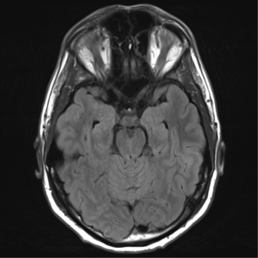 File:Arachnoid cyst - cerebellopontine angle (Radiopaedia 59689-67083 Axial FLAIR 14).png
