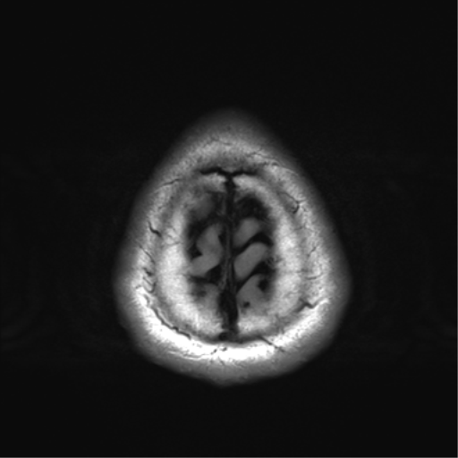 File:Arachnoid cyst - cerebellopontine angle (Radiopaedia 59689-67083 Axial FLAIR 36).png