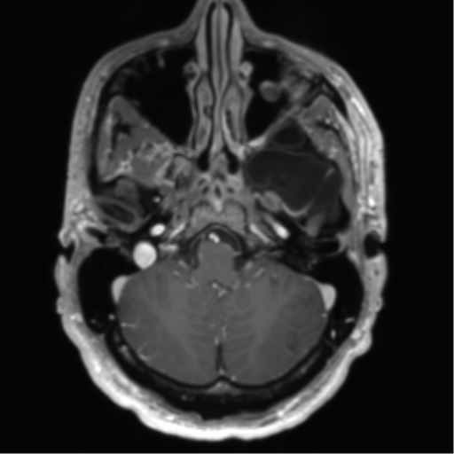 Arachnoid cyst with subdural hematoma (Radiopaedia 85892-101743 Axial T1 C+ 20).png