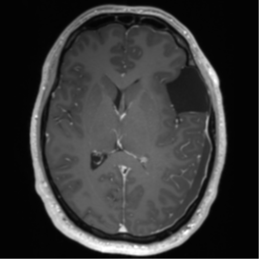 Arachnoid cyst with subdural hematoma (Radiopaedia 85892-101743 Axial T1 C+ 47).png