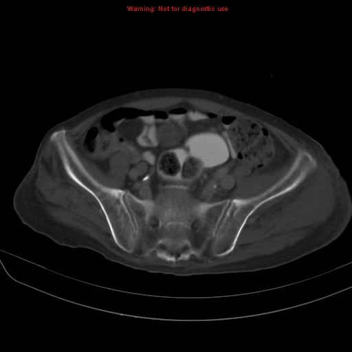 File:Arachnoiditis ossificans (Radiopaedia 51394-57136 Axial bone window 34).jpg