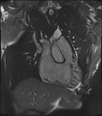 Arrhythmogenic right ventricular cardiomyopathy (Radiopaedia 57972-64966 CINE R2 SSFP 33).jpg
