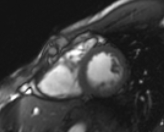 File:Arrhythmogenic right ventricular cardiomyopathy (Radiopaedia 69564-79464 short axis cine 104).jpg