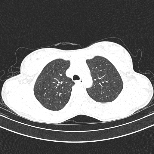 Arteria lusoria (Radiopaedia 88528-105192 Axial lung window 20).jpg