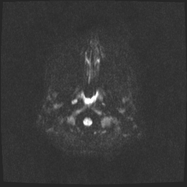 Arteriovenous malformation (Radiopaedia 63693-72385 DWI 41).jpg