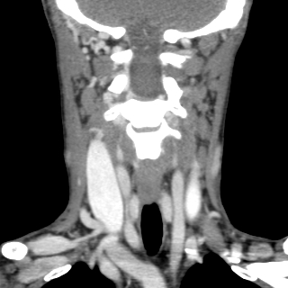 File:Arteriovenous malformation of the neck (Radiopaedia 53935-60062 D 3).jpg