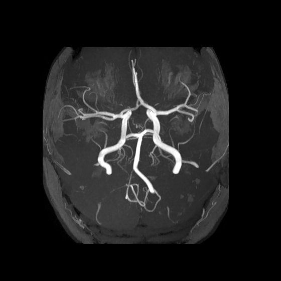Artery of Percheron infarct (Radiopaedia 40966-43676 F 17).jpg