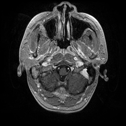 File:Artery of Percheron infarction (Radiopaedia 27975-28230 Axial T1 C+ fat sat 12).jpg