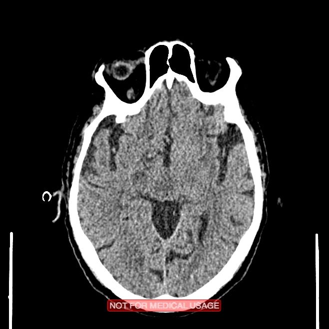 Artery of Percheron infarction (Radiopaedia 28679-28967 Axial non-contrast 53).jpg