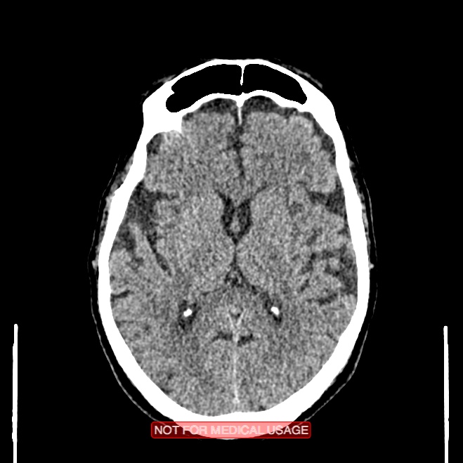Artery of Percheron infarction (Radiopaedia 28679-28967 Axial non-contrast 63).jpg