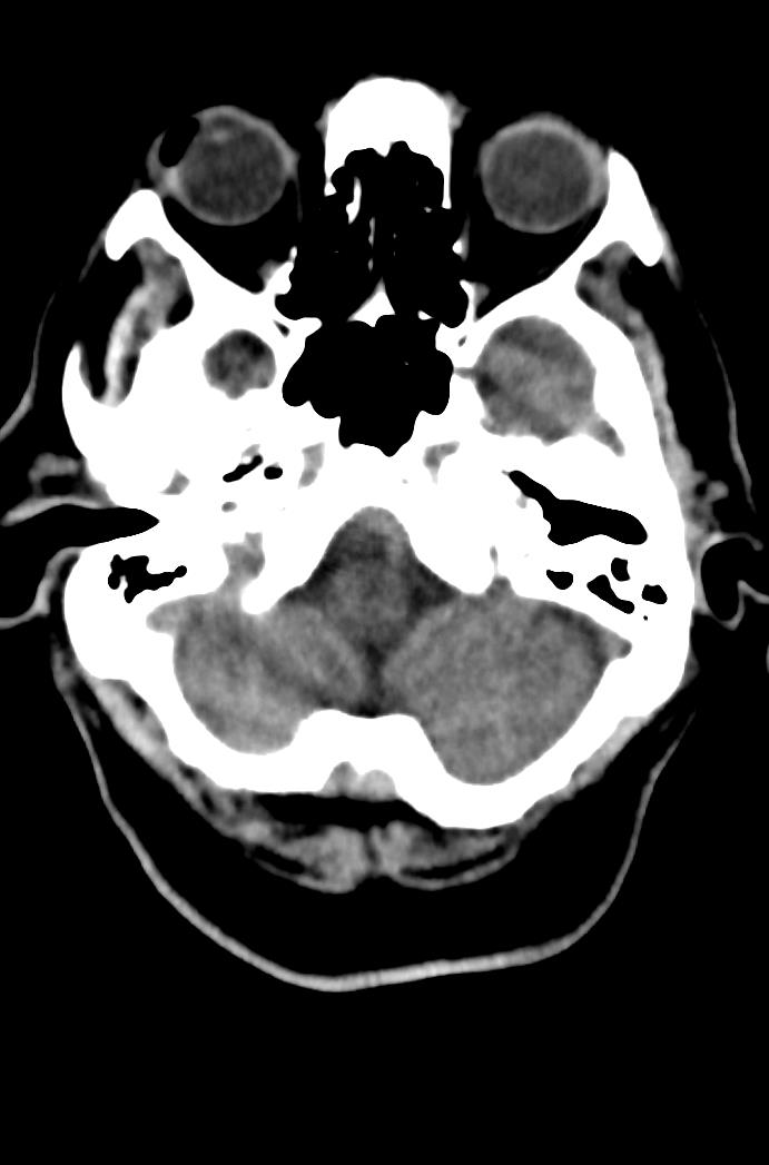 Artery of Percheron infarction (Radiopaedia 80613-94202 Axial non-contrast 41).jpg