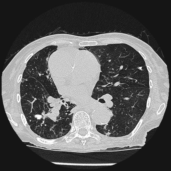 Aspergilloma (Radiopaedia 24458-24763 Axial lung window 35).jpg