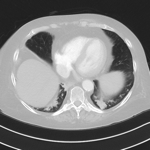 Aspiration bronchiolitis (Radiopaedia 53464-59463 Axial lung window 42).png