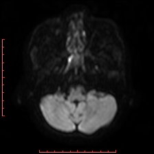File:Astroblastoma (Radiopaedia 74287-85162 Axial DWI 15).jpg