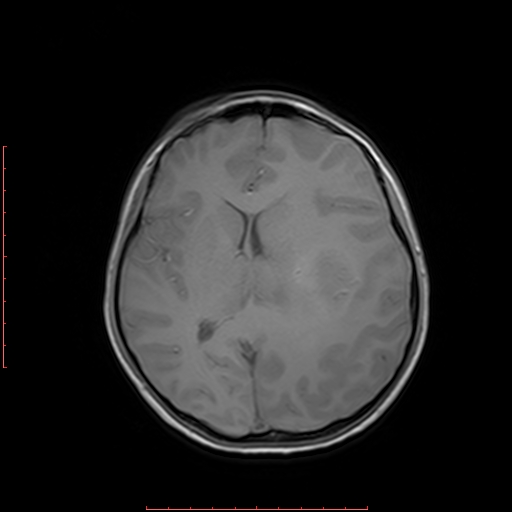 File:Astroblastoma (Radiopaedia 74287-85162 Axial T1 12).jpg