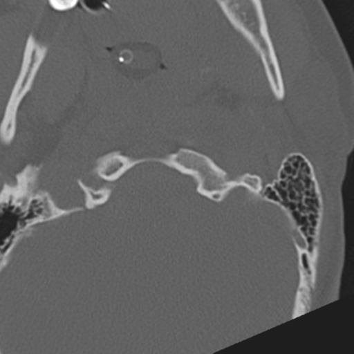 File:Atlanto-occipital dissociation (Radiopaedia 33848-35013 Axial bone window 4).png