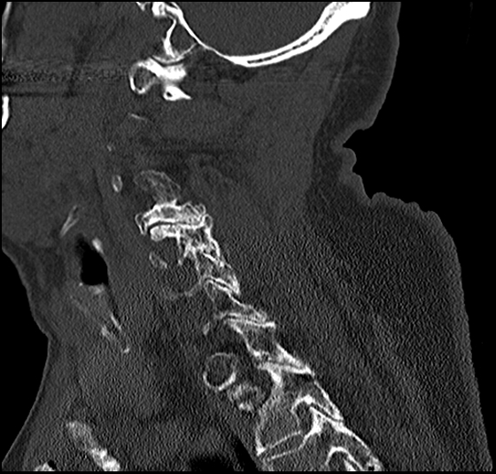 File:Atlas (type 3b subtype 1) and axis (Anderson and D'Alonzo type 3, Roy-Camille type 2) fractures (Radiopaedia 88043-104607 Sagittal bone window 31).jpg
