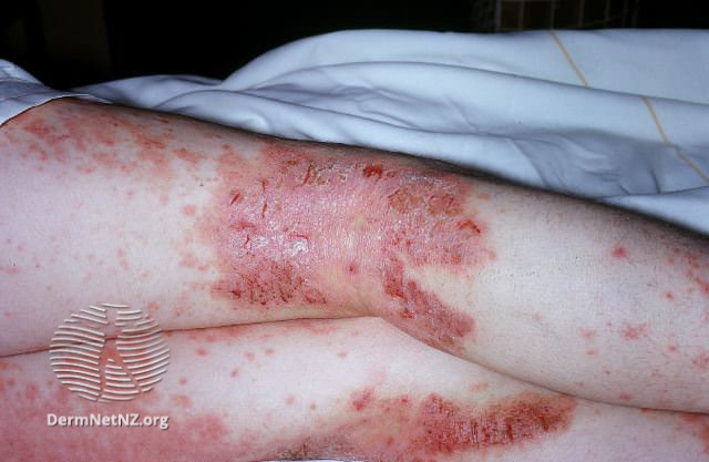 File:Atopic dermatitis (DermNet NZ dermatitis-flexural-eczema03).jpg