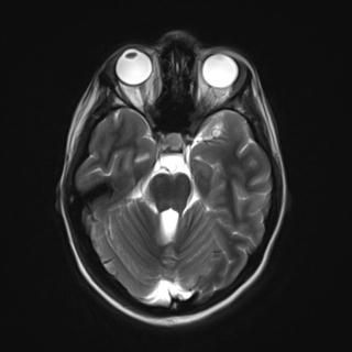 File:Atretic encephalocoele with inferior vermis hypoplasia (Radiopaedia 30443-31108 Axial T2 7).jpg