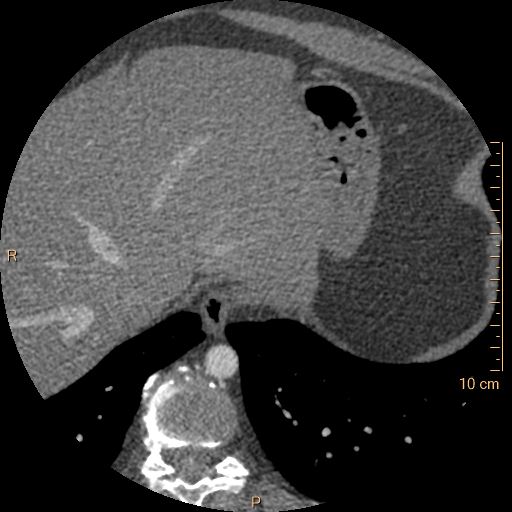 Atrial septal defect (upper sinus venosus type) with partial anomalous pulmonary venous return into superior vena cava (Radiopaedia 73228-83961 A 274).jpg