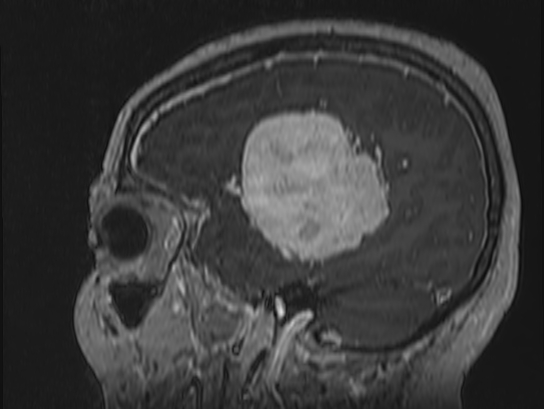 Atypical meningioma (Radiopaedia 62985-71406 Sagittal T1 C+ 73).jpg