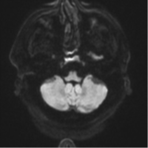 File:Atypical meningioma (WHO grade II) with brain invasion (Radiopaedia 57767-64729 Axial DWI 36).png