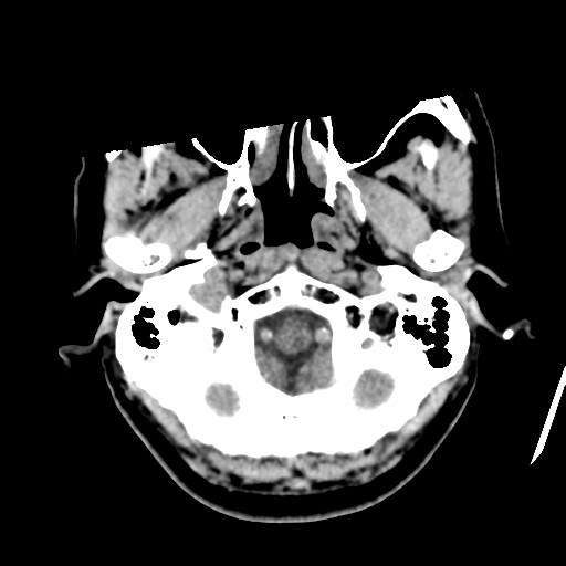 Atypical meningioma with skull invasion (Radiopaedia 34357-35649 Axial non-contrast 8).png