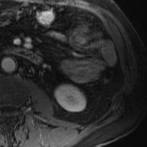 File:Atypical renal cyst on MRI (Radiopaedia 17349-17046 D 27).jpg