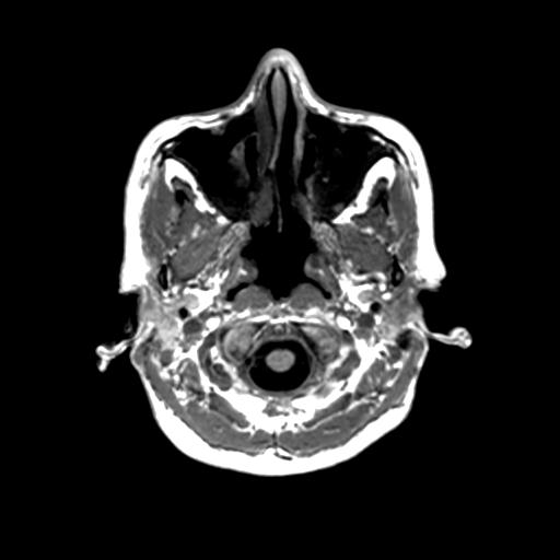 Autoimmune limbic encephalitis (Radiopaedia 30363-31005 T1 Axial 1mm 16).jpg
