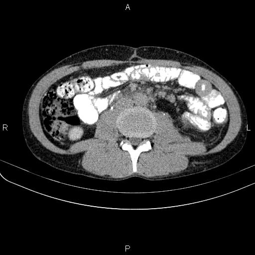 Autoimmune pancreatitis (Radiopaedia 84925-100431 Axial C+ delayed 45).jpg