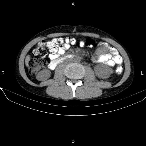 Autoimmune pancreatitis (Radiopaedia 84925-100431 Axial non-contrast 30).jpg