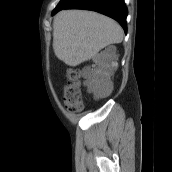 Autosomal dominant polycystic kidney disease (Radiopaedia 36539-38101 D 16).jpg