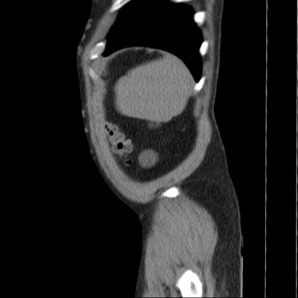 Autosomal dominant polycystic kidney disease (Radiopaedia 36539-38101 D 76).jpg
