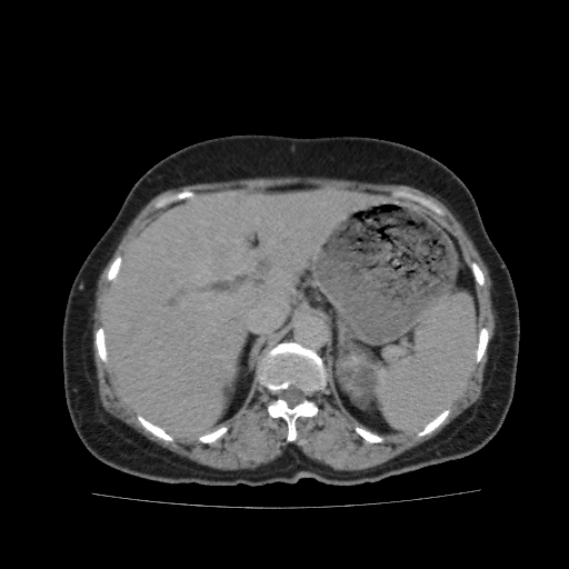 Autosomal dominant polycystic kidney disease (Radiopaedia 38189-40194 Axial C+ delayed 10).jpg