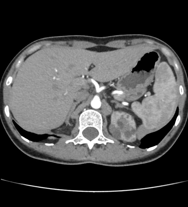 Autosomal dominant polycystic kidney disease - early onset (Radiopaedia 40734-43387 B 3).jpg