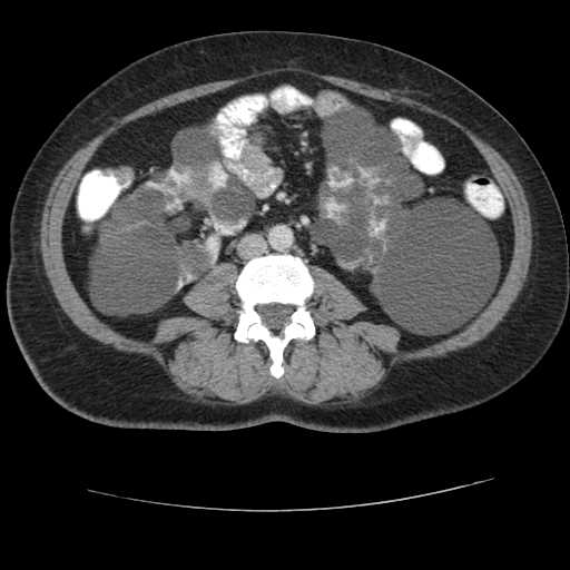Autosomal dominant polycystic kidney disease with hepatic involvement (Radiopaedia 32693-33662 B 46).jpg