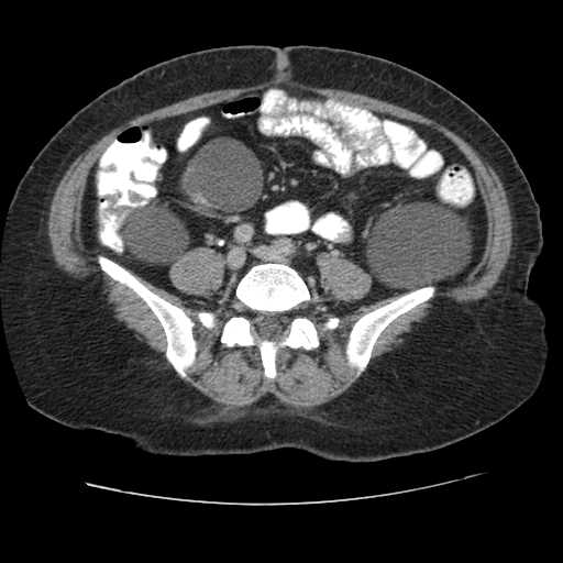 Autosomal dominant polycystic kidney disease with hepatic involvement (Radiopaedia 32693-33662 C 55).jpg