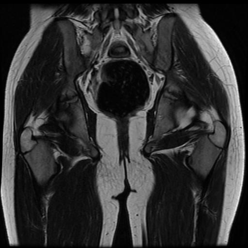 File:Avascular necrosis of the hip (Radiopaedia 29563-30067 Coronal T2 12).jpg