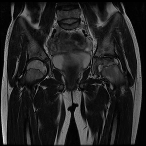 File:Avascular necrosis of the hip (Radiopaedia 29563-30067 Coronal T2 7).jpg