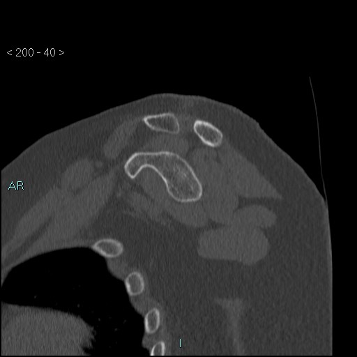 File:Avascular necrosis of the shoulder - Cruess stage I (Radiopaedia 77674-89887 Sagittal bone window 39).jpg