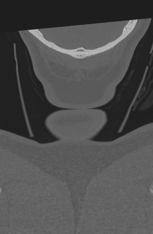 Axis peg fracture (type 3) and atlas lateral mass (type 4) fracture (Radiopaedia 37474-39324 Coronal bone window 75).png