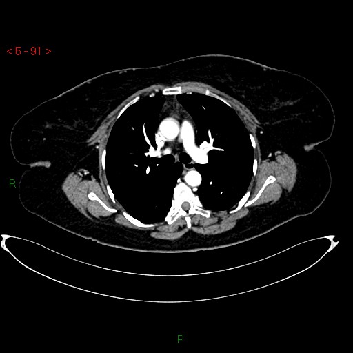Azygos fissure and lobe (Radiopaedia 47620-52278 A 77).jpg