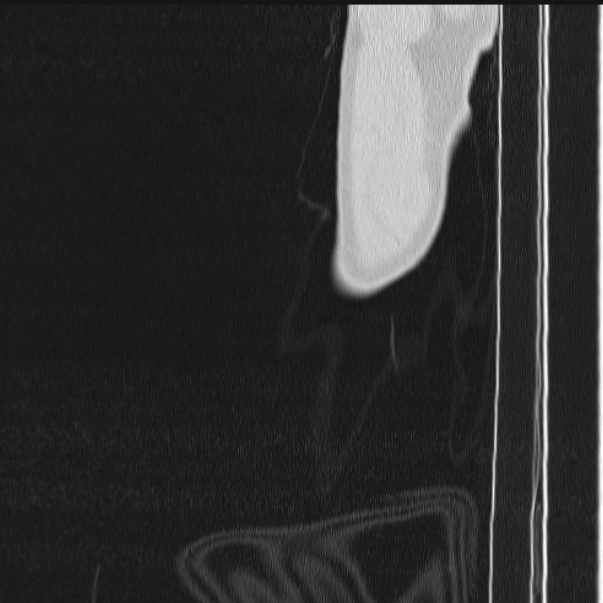 Azygos lobe (Radiopaedia 38259-40275 lung window 1).jpg
