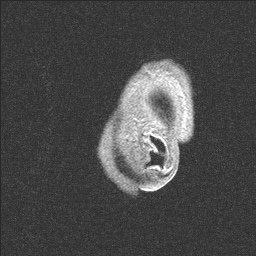 Balo concentric sclerosis (Radiopaedia 50458-55940 Sagittal T1 12).jpg