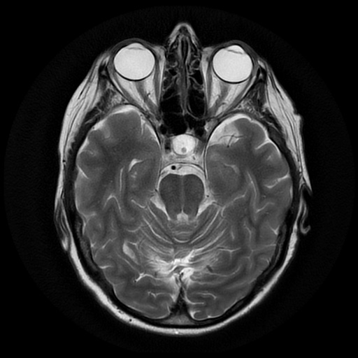 File:Balo concentric sclerosis (Radiopaedia 53875-59982 Axial T2 9).jpg
