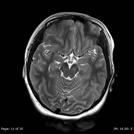 File:Balo concentric sclerosis (Radiopaedia 61637-69636 Axial T2 11).jpg