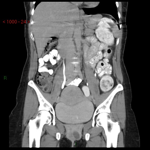 File:Bartholin gland cyst (Radiopaedia 54904-61181 Coronal C+ delayed 24).jpg