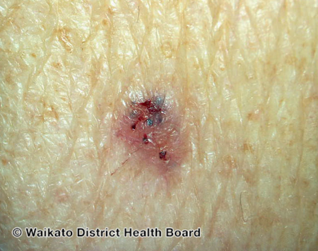 File:Basal cell carcinoma, arm (DermNet NZ bcc-arm-18-wdhb).jpg