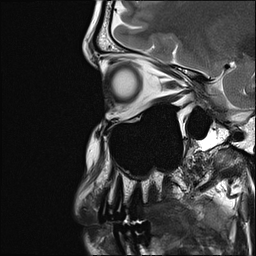 File:Basal cell carcinoma - nasal region (Radiopaedia 70292-80365 Sagittal T2 17).jpg